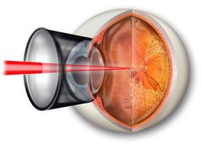 全系光凝---眼底病的激光疗法 昆明华山眼科医院