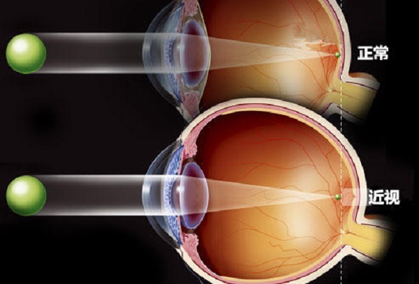 如何预防眼睛近视?