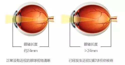 600度以上高度近视，ICL让你安全摘镜